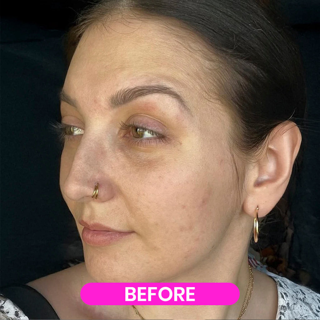 Mónare 4% Retinal Liposome Cream