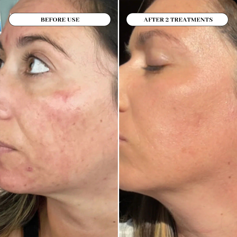 Anti Aging Facial micro needling Box