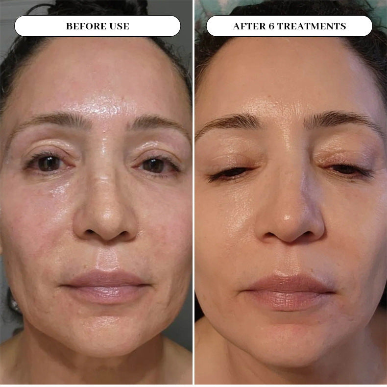 Anti Aging Facial micro needling Box